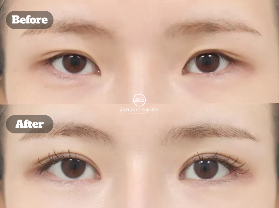 Clinical before and after comparison of epicanthoplasty focusing on epicanthal fold reduction