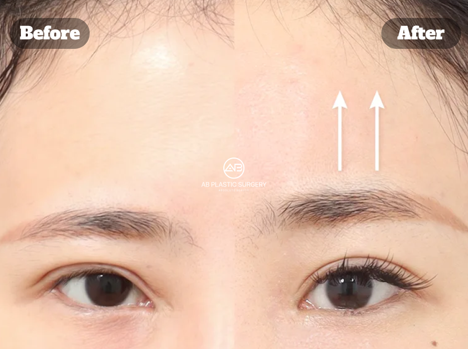 Before and after comparison of Endotine lift showing forehead and brow elevation