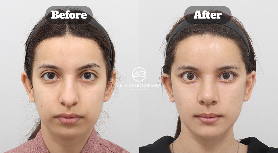 Before and after comparison of hump nose rhinoplasty showing smoother nasal bridge
