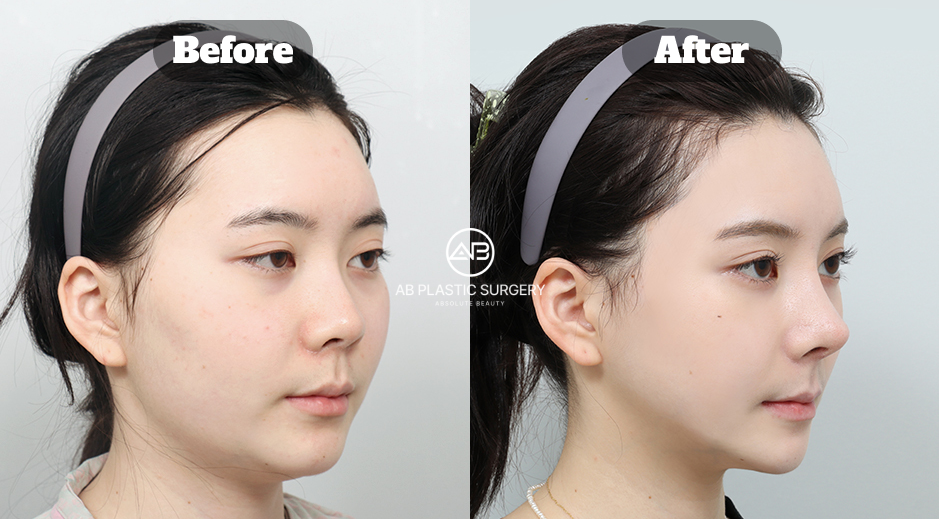 Before and After Results of Jaw and Cheekbone Reduction Surgery in South Korea