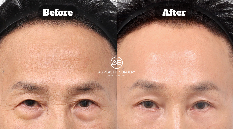 Before and after image of male forehead lift combined with lower blepharoplasty