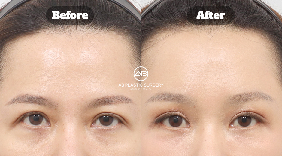 Before and after comparison of female forehead lift surgery