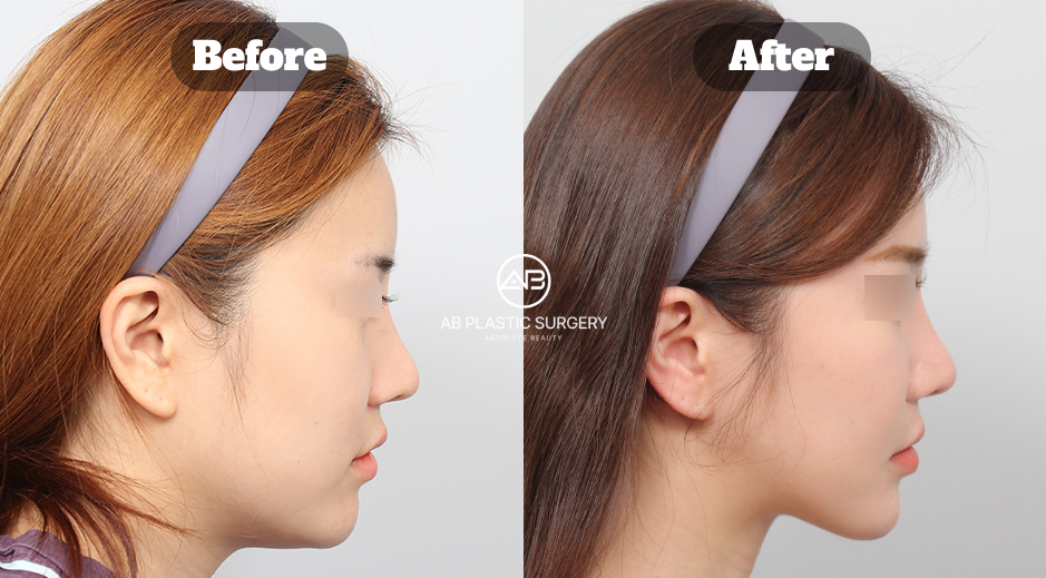 Before and After Results of Jaw, Cheekbone, Chin Surgery with Facial Fat Grafting in Korea