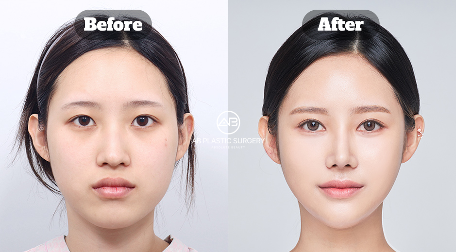 Before and after comparison of natural rhinoplasty showing balanced facial harmony