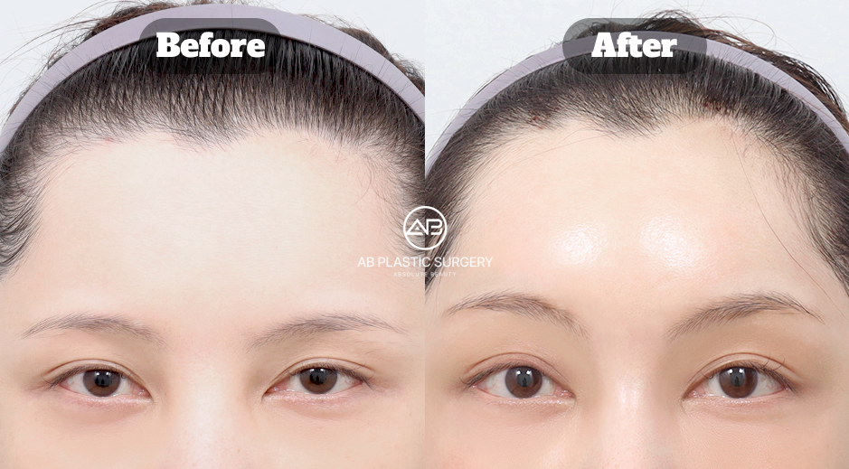Before and after review image of female forehead lift surgery