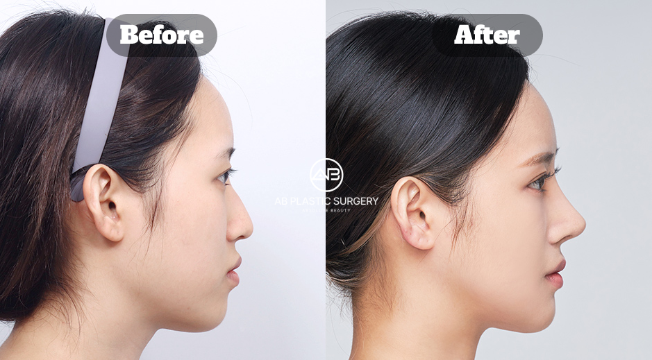 Side profile comparison before and after Korean rhinoplasty showing refined nose line
