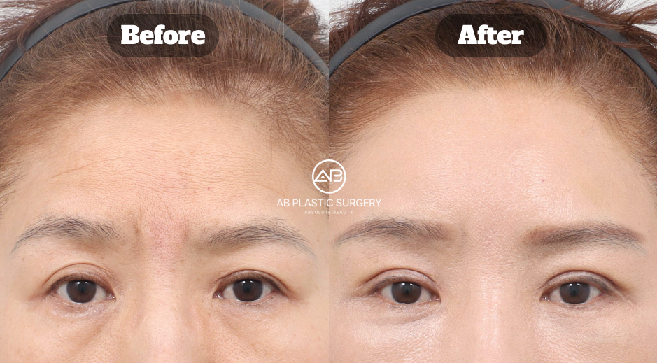 Before and after review of female forehead lift combined with upper and lower blepharoplasty
