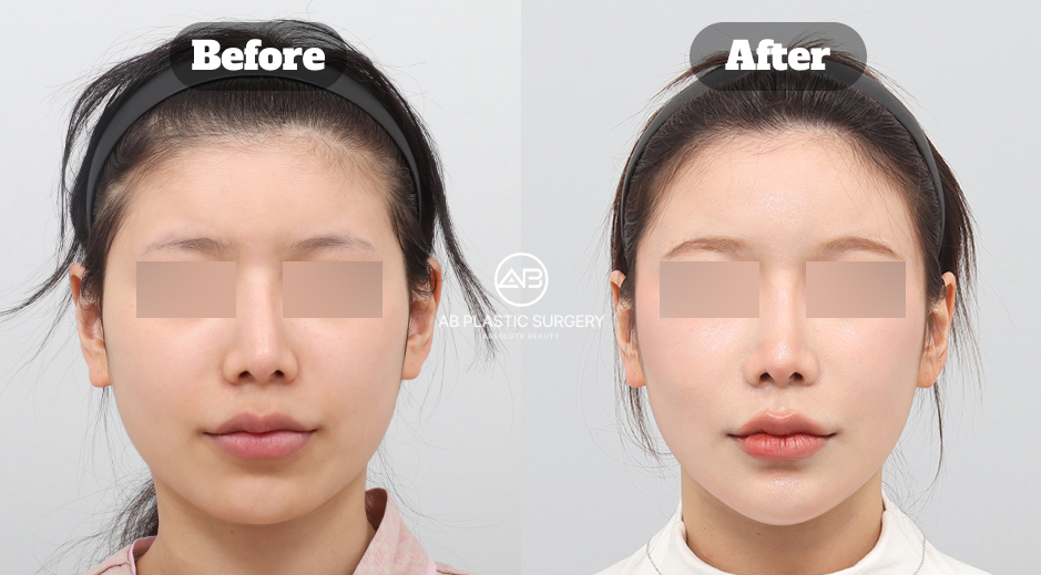 Before and After Results of Jaw, Cheekbone, and Chin Contouring Surgery in South Korea