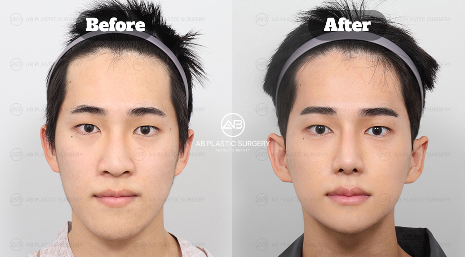 Before and after comparison of male rhinoplasty showing refined masculine nose shape
