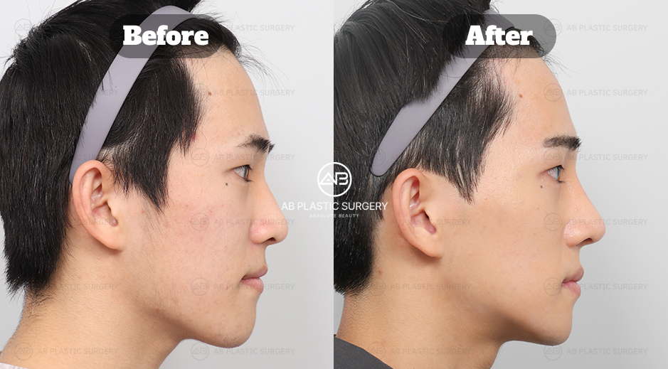Before and after comparison of male rhinoplasty in South Korea showing balanced nose profile