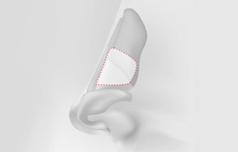 Septal cartilage rhinoplasty material