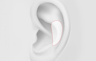 Ear cartilage rhinoplasty material