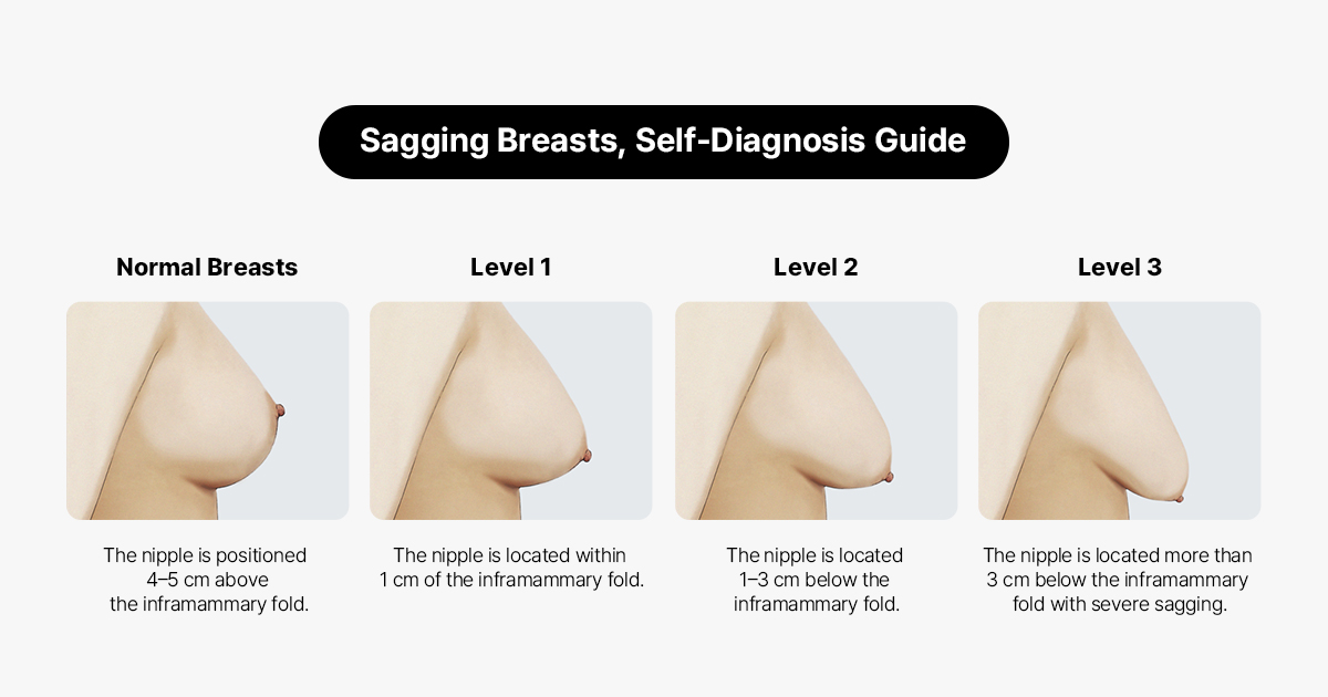 Self Diagnosis for Sagging Breasts