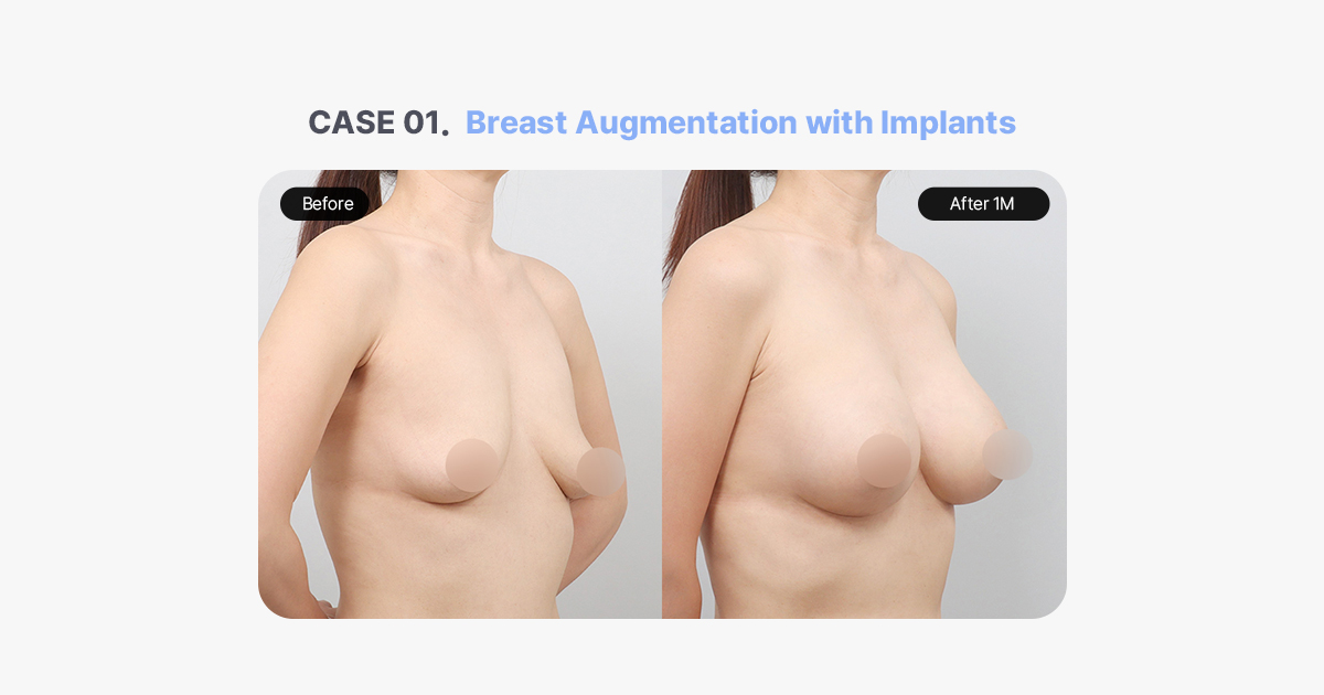 Before and After Breast Augmentation with Implants