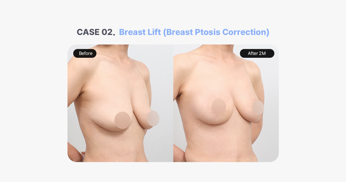 Before and After Breast Lift for Breast Ptosis Correction
