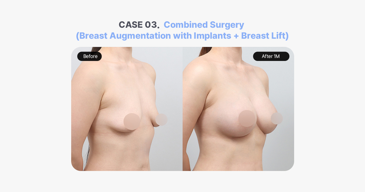 Before and After Combined Surgery Breast Augmentation with Implants and Breast Lift