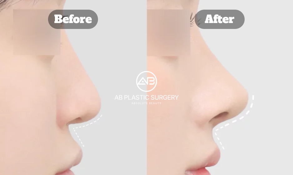 Side Profile Comparison of Korean Nose Job Before and After Showing Structural Rhinoplasty Result