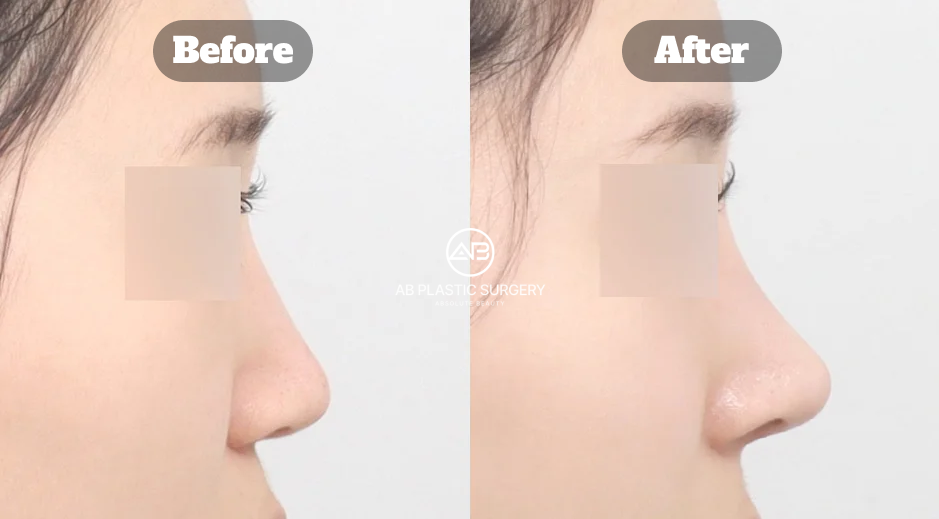 Korean Nose Job Before and After Showing Revision Rhinoplasty With Long Nose and Deviated Nose Correction