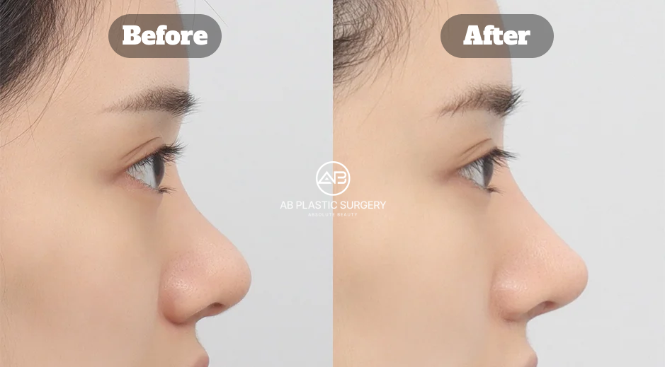 Korean Nose Job Before and After Showing Bulbous Nose and Deviated Nose Correction With Alar Reduction