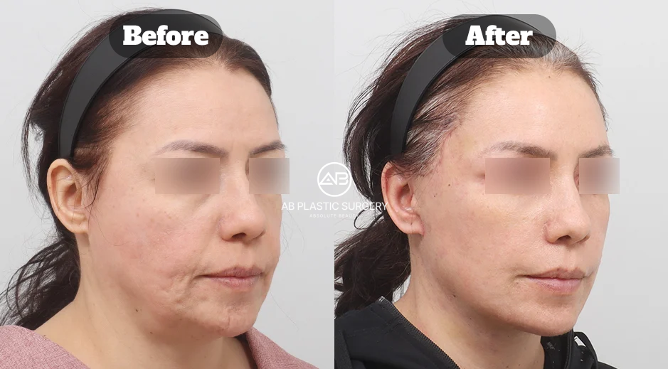 Before and after deep plane facelift Korea with forehead lift, neck lift, cheek fat removal, and facial fat grafting for balanced facial rejuvenation