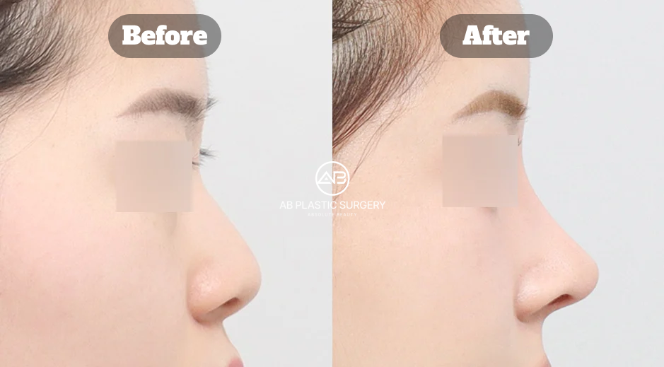 Korean Nose Job Before and After Showing Functional Rhinoplasty With Short Nose and Bulbous Tip Correction