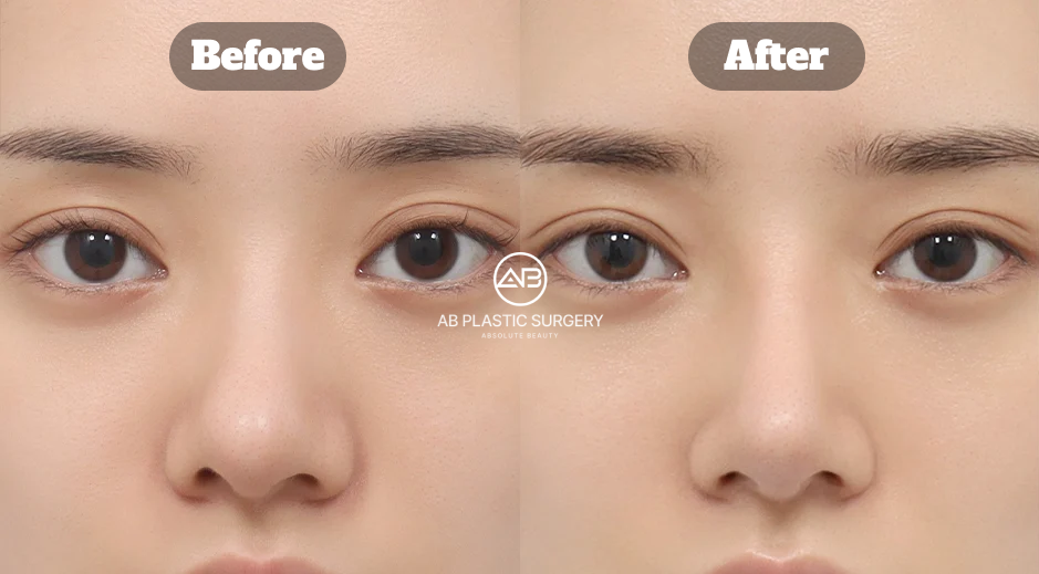 Before and After Asian Rhinoplasty in Korea Including Revision, Bulbous Nose Correction, Deviated Nose Repair, and Alar Reduction at AB Plastic Surgery