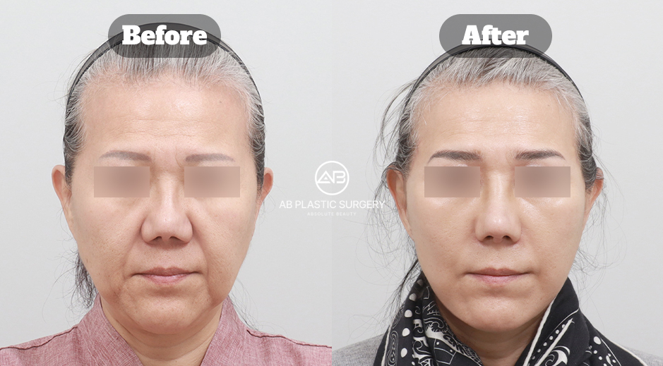 Frontal comparison after deep plane facelift Korea combined with neck lift, forehead lift, forehead reduction, and facial fat grafting