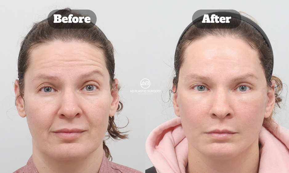Deep plane facelift Korea before and after showing midface lift, jawline tightening, and natural structural rejuvenation