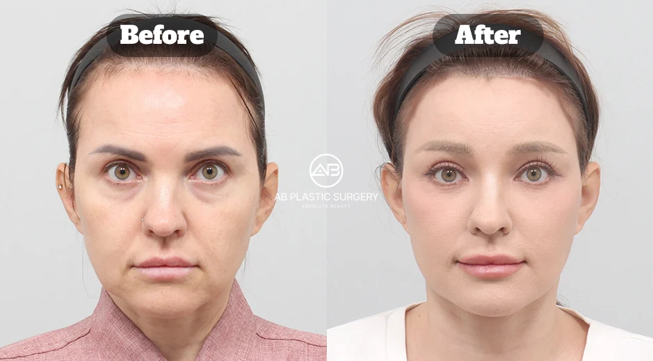 Before And After Results Of Facelift Surgery Rhytidectomy In Korea Showing Natural Lifting And Smoother Facial Contours