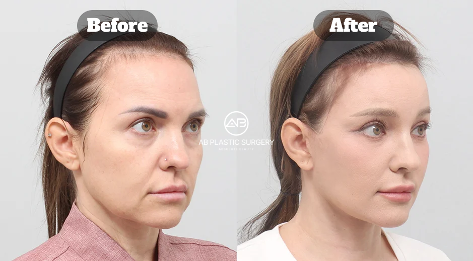Before And After Facelift Surgery Rhytidectomy In Korea Combining SMAS Lift Forehead Lift Neck Lift And Facial Fat Grafting For Natural Rejuvenation