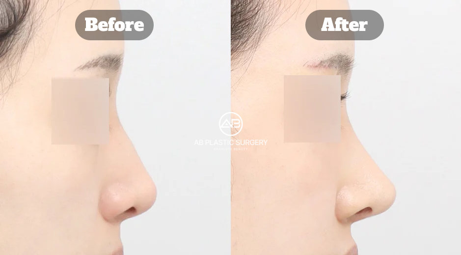 Korean Nose Job Before and After Showing Hump Nose Correction and Implant Free Revision Rhinoplasty