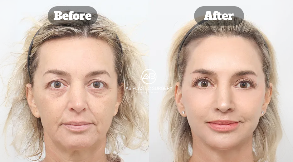 Before And After Results Of Facelift Surgery Rhytidectomy In Korea With SMAS Lift Neck Lift Eyelid Surgery Brow Lift Philtrum Reduction And Facial Fat Grafting