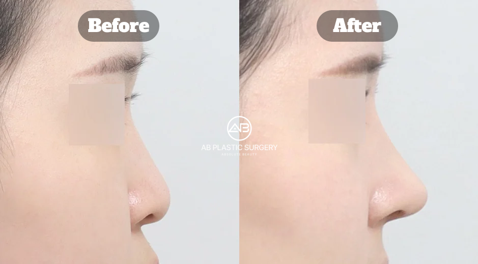 Korean Nose Job Before and After Showing Bulbous and Deviated Nose Correction With Osteotomy Rhinoplasty