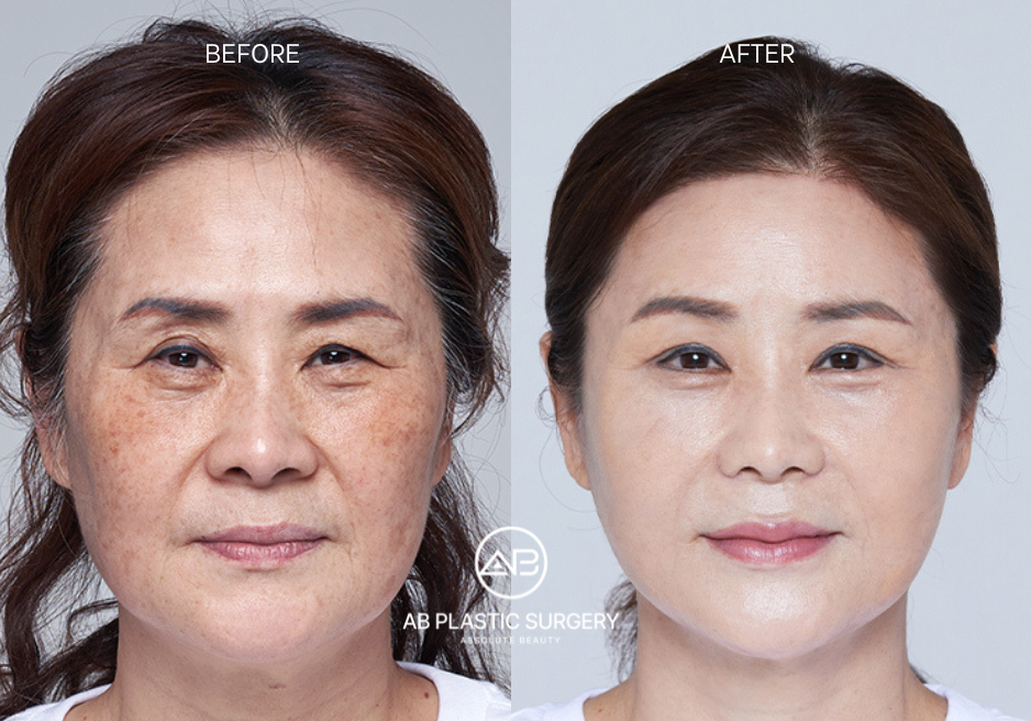 plastic surgery in korea before after comparison demonstrating improved facial symmetry and harmony