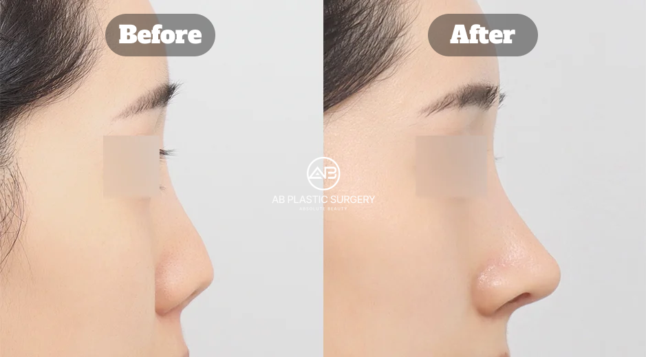 Korean Nose Job Before and After Showing Short Nose Correction With Revision Osteotomy Rhinoplasty