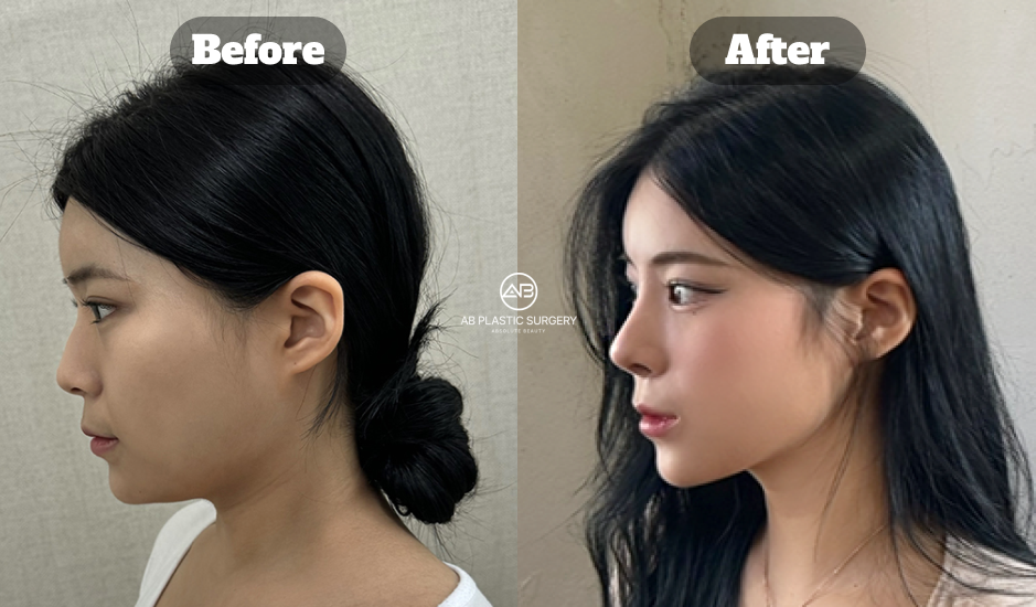 Korean Nose Job Before and After Showing Low Nose Bridge Augmentation and Profile Improvement