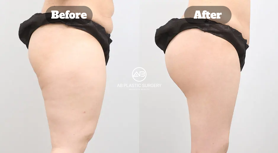 Before and after example of body contouring in Korea using thigh liposuction and buttock fat grafting