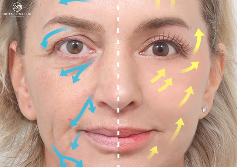Illustration explaining facial sagging vectors and lifting vectors in deep plane facelift Korea technique
