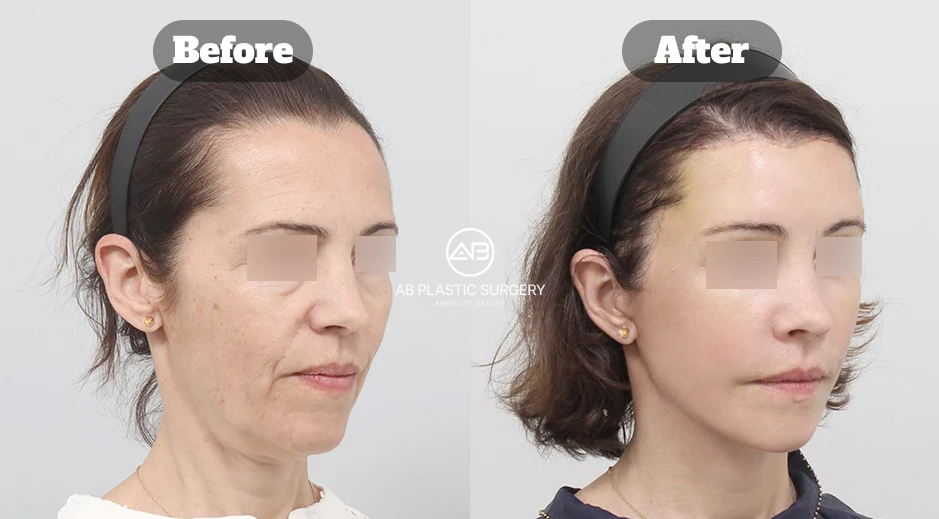 Before And After Facelift Surgery Rhytidectomy In Korea With SMAS Lift Endotine Forehead Lift Neck Lift Platysma Tightening And Facial Fat Grafting