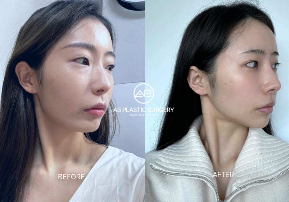 before and after plastic surgery in korea showing aesthetic transformation with clearer features and balanced proportions