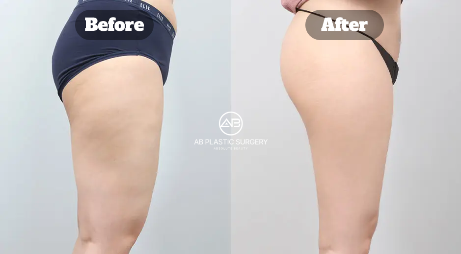 Before and after thigh liposuction in Korea showing improved lower body contour and subtle buttock lift effect