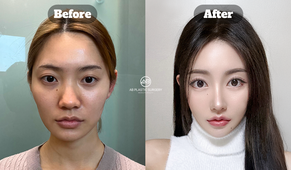 Korean Nose Job Before and After Showing Alar Reduction and Narrowed Nasal Base Result