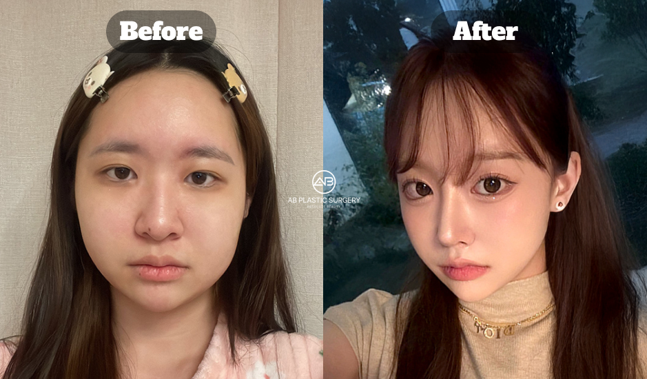 Korean Nose Job Before and After Showing Bulbous Nose, Hump Nose, and Long Nose Correction Result