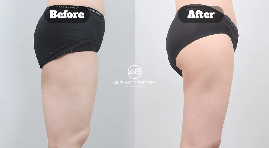 Before and after thigh liposuction in Korea highlighting smoother hip contour and enhanced buttock lift appearance