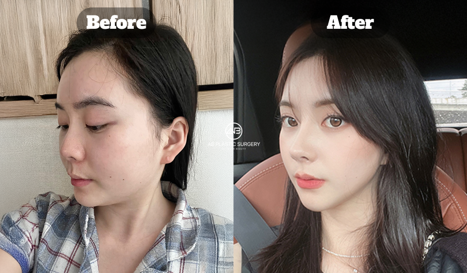 Korean Nose Job Before and After Showing Short Nose Elongation and Improved Nasal Tip Projection