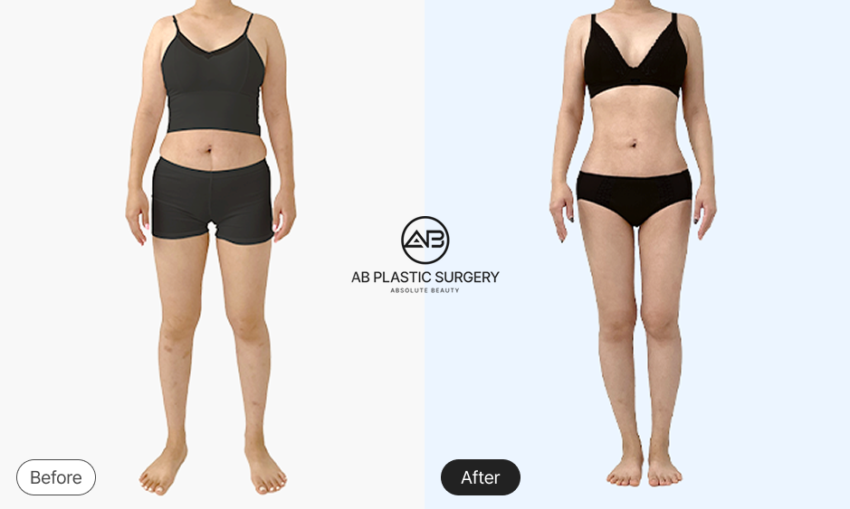 Before and after full body liposuction in Korea showing improved waistline and balanced body contour