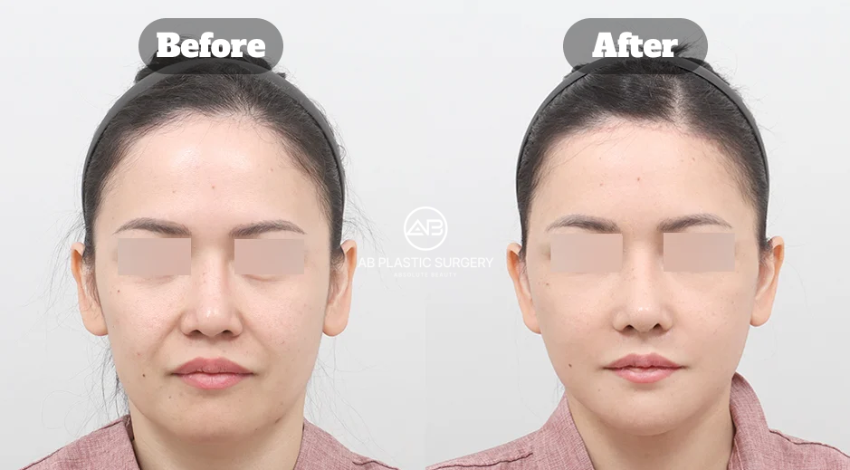 Frontal before and after image of deep plane facelift Korea combined with forehead lift, forehead reduction, neck lift, and facial fat grafting