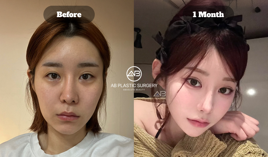 One Month Before And After Results Of Korean Eye Plastic Surgery Revision Showing Refined Eye Shape And Overall Facial Balance Improvement