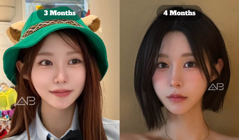 Comparison Of Korean Eye Plastic Surgery Revision Results At 3 Months And 4 Months Showing Stabilized Eye Shape And Natural Healing Progress
