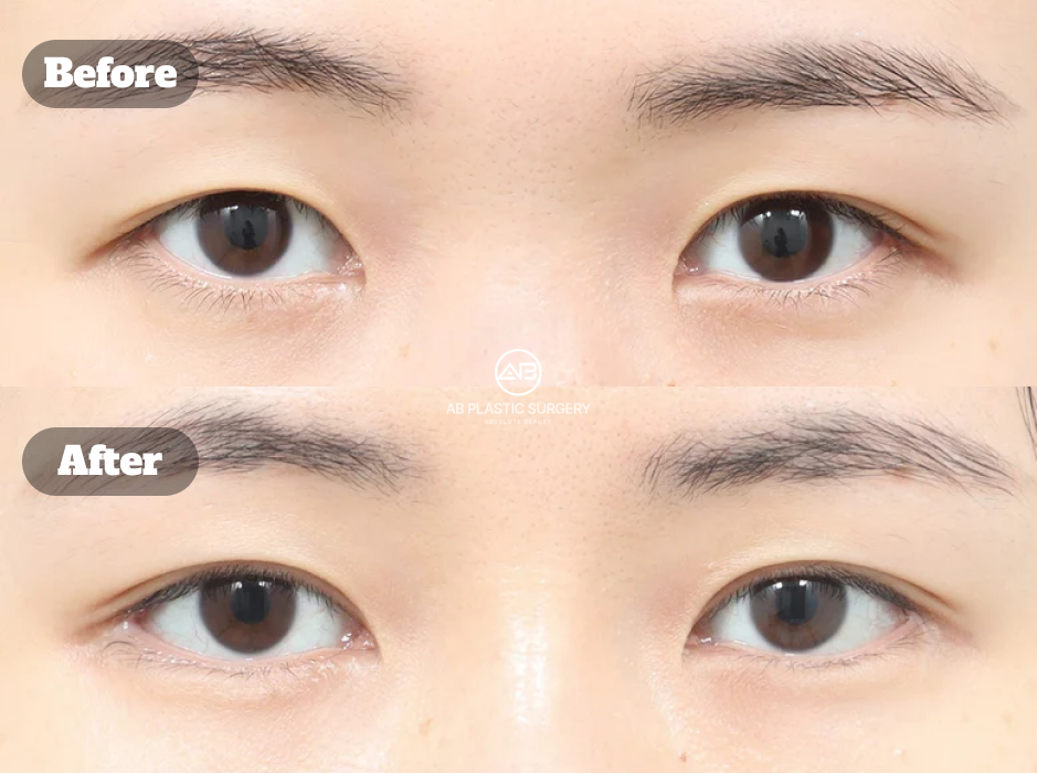 Before And After Results Of Korean Eye Plastic Surgery Including Revision Eyelid Surgery Eye Shape Correction Epicanthoplasty And Lateral Canthoplasty
